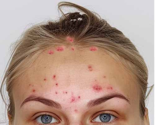 Acne on Scalp--Pimples on the Scalp