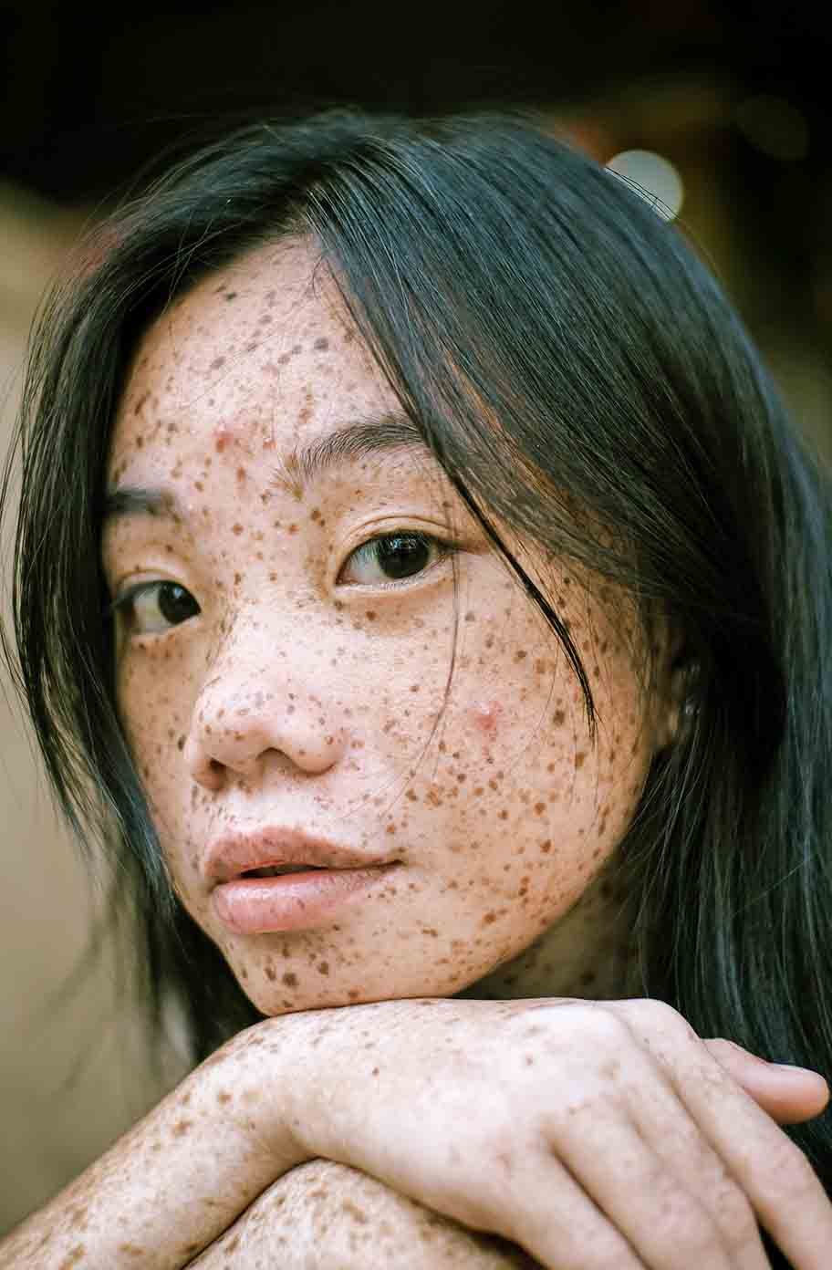 12 Best Home Remedies for Hyperpigmentation