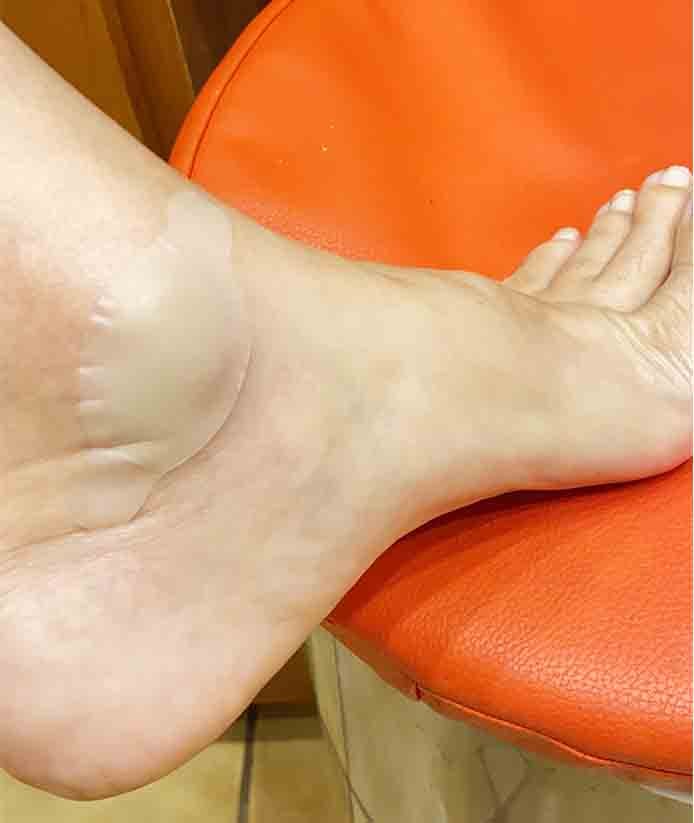 How Do Hydrocolloid Patches Work On Blisters